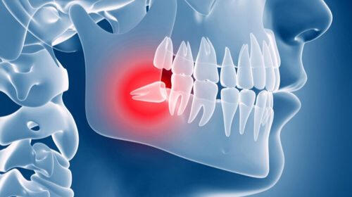 Wisdom Tooth Removal