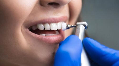 Dental Cleaning & Polishing