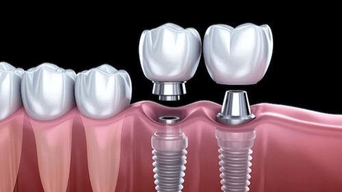Dental Implants